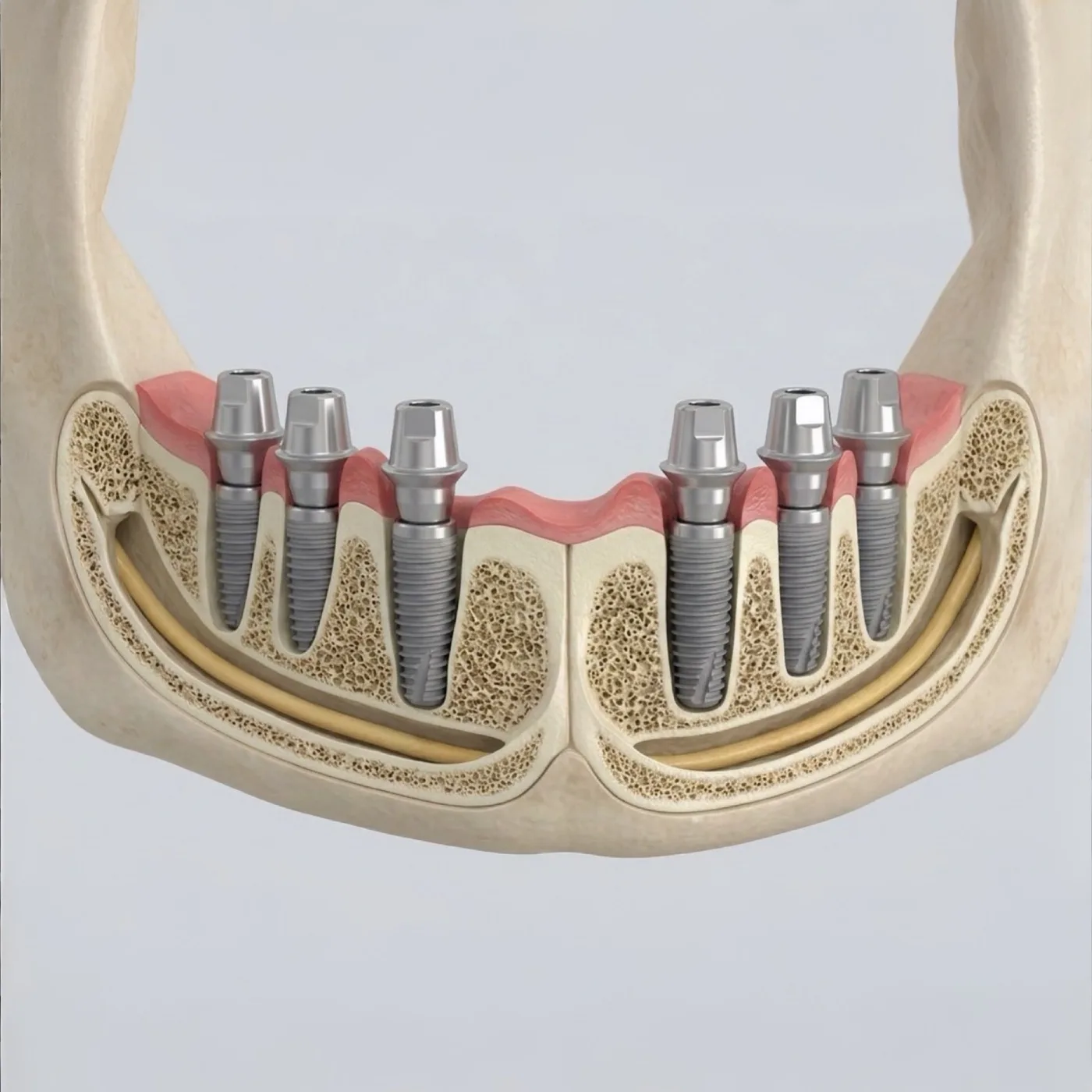 Sabit dişler için implant destekli protez planlaması